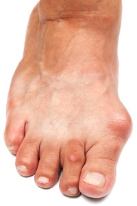 Bunions and How They are Treated