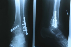 Healthy Foods And Stress Fractures