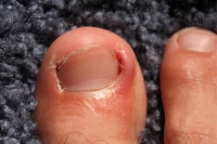 How Do I Know If My Child Has An Ingrown Toenail?