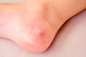 Fracture Blisters Need Prompt Attention