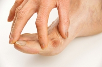 What Causes a Bunion to Form?