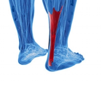 What to Know About Achilles Tendon Injuries